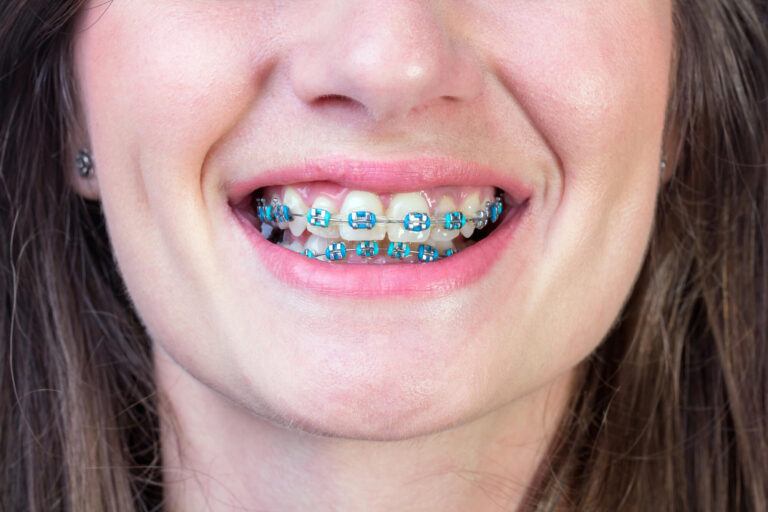 teal braces