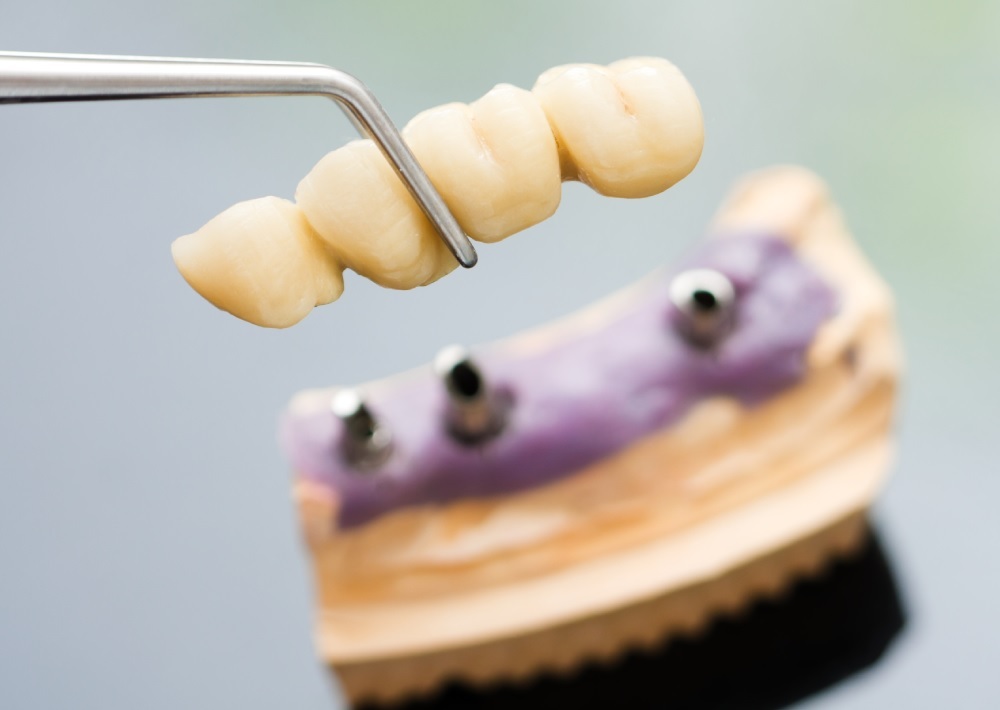 dental full mouth implants